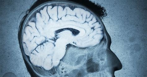 Mega Cisterna Magna Symptoms, Causes, Headache, Treatment.